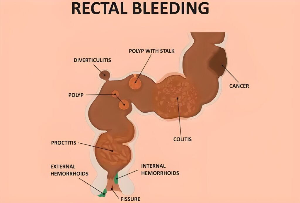 Common Rectal Bleeding