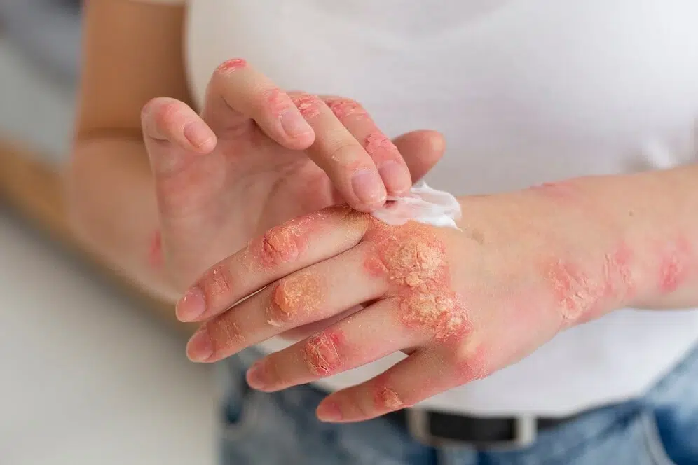 Eczema