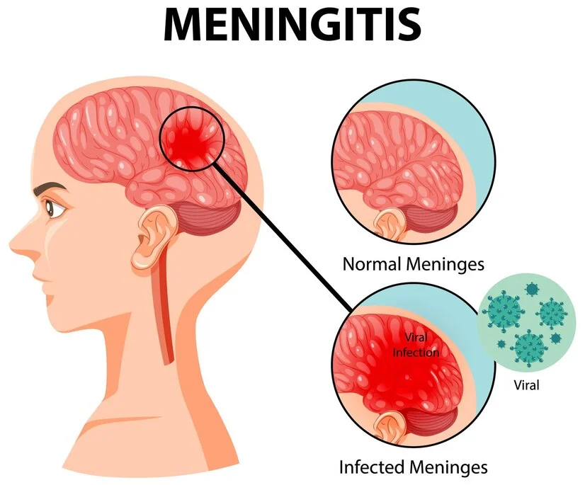 Meningitis