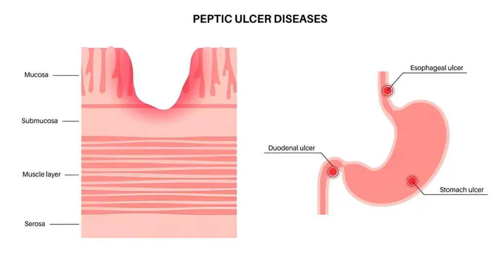 Peptic Ulcer