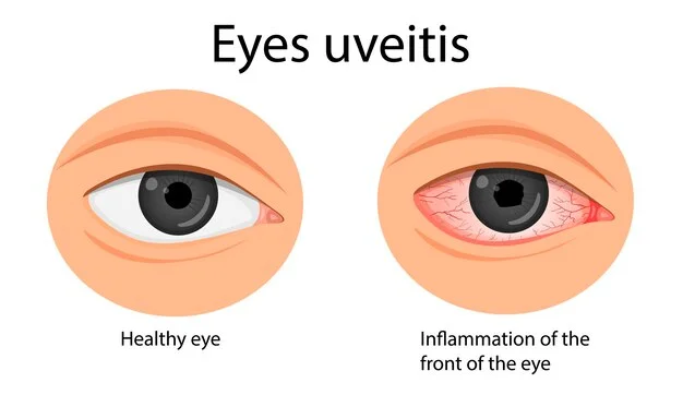 Uveitis