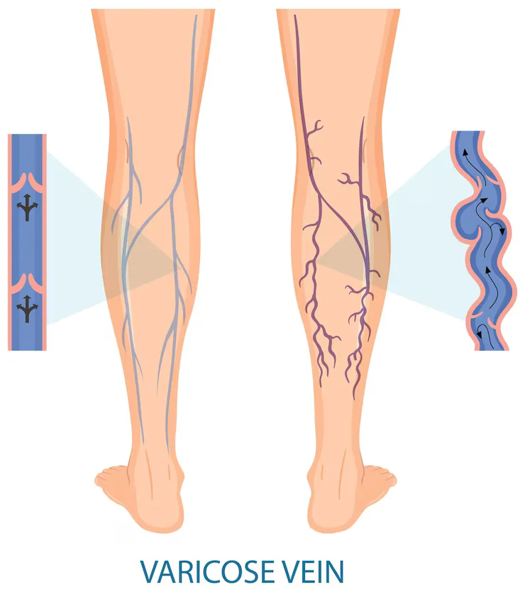 Varicose Veins